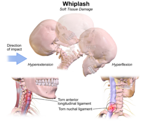 whiplash injury lawyer las vegas