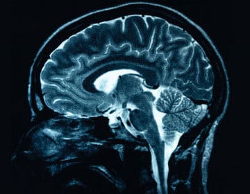 Traumatic Brain Injury: What Is It, and How Does It Damage Your Life?
